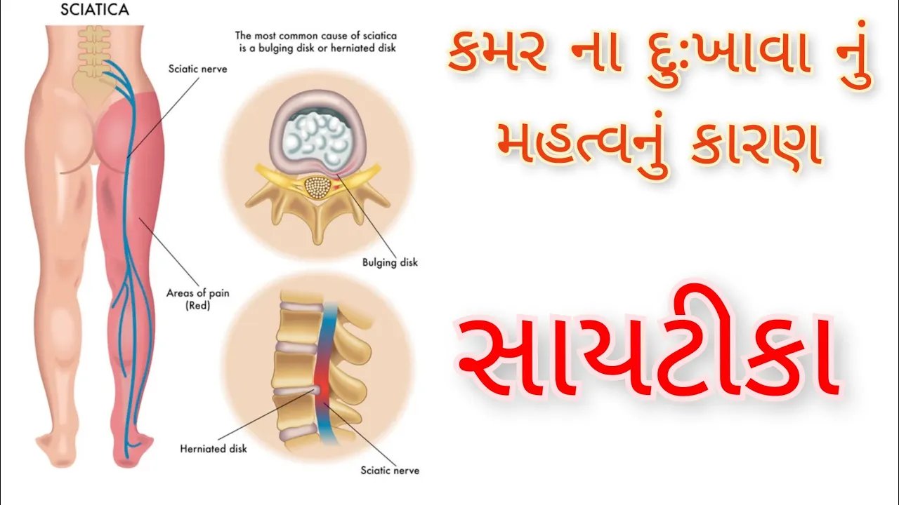 સાયટીકા એટલે શું? | Sciatica Pain | What is Sciatica | dr.padhiyar