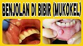 Lumps on the Lips - Causes and Treatment
