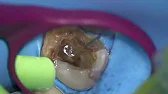 Management of Calcified Canals