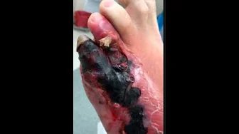 Diabetic Gas Gangrene