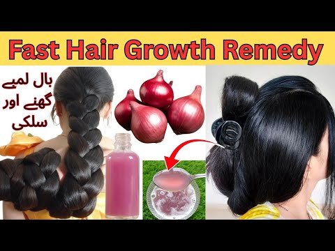 Onion Juice For Extreme Hair Growth: Stop Hai...