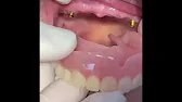 Snap in Dentures