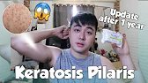UPDATE SA KERATOSIS PILARIS KO ( chicken skin ) AFTER 1 YEAR 😳😥
